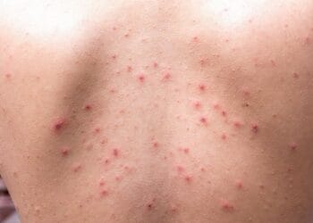 Mengatasi Jerawat Punggung