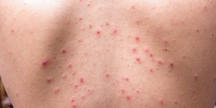 Kandungan Skincare yang Ampuh Untuk Mengatasi Jerawat Punggung 1 Mengatasi Jerawat Punggung