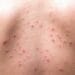 Kandungan Skincare yang Ampuh Untuk Mengatasi Jerawat Punggung 8 Mengatasi Jerawat Punggung