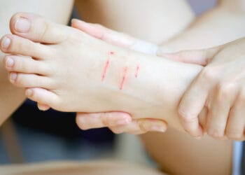 Cara Menghilangkan Bekas Luka di Kaki