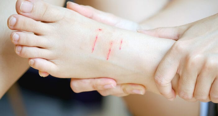 Cara Menghilangkan Bekas Luka di Kaki