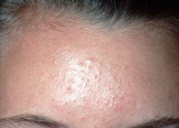 Cara Menghilangkan Bruntusan di Wajah