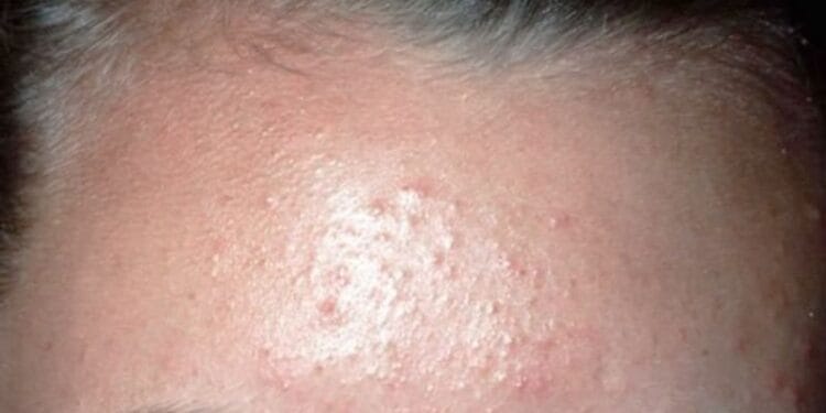 Cara Menghilangkan Bruntusan di Wajah