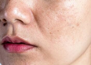 Cara Menghilangkan Flek Hitam di Wajah