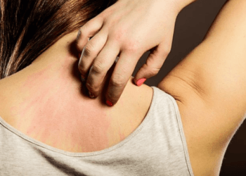 Cara Menghilangkan Gatal Pada Kulit Yang Tak Kunjung Sembuh