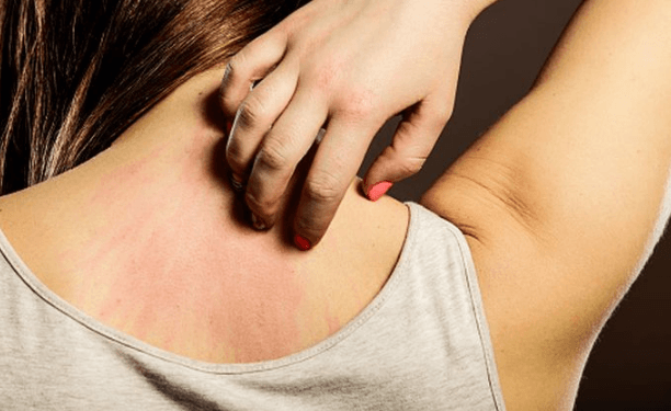 Cara Menghilangkan Gatal Pada Kulit Yang Tak Kunjung Sembuh