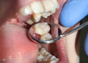 5 Cara Membersihkan Karang Gigi Secara Alami dan Cepat 7 Cara Menghilangkan Karang Pada Gigi