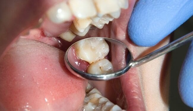 5 Cara Membersihkan Karang Gigi Secara Alami dan Cepat 1 Cara Menghilangkan Karang Pada Gigi