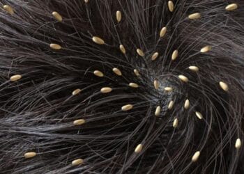 Cara Menghilangkan Kutu Rambut