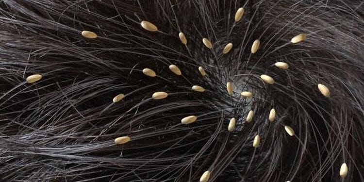 Cara Menghilangkan Kutu Rambut