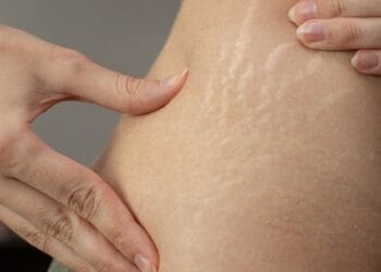 Cara Menghilangkan Stretch Mark