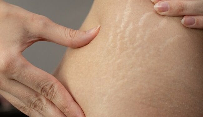 Cara Menghilangkan Stretch Mark