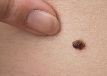 Cara Menghilangkan Tahi Lalat