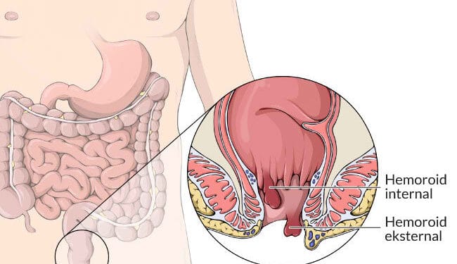 Ini 4 Cara Alami Meredakan Gejala Ambeien / Wasir Secara Alami dan Cepat 1 Cara Mengobati Ambeien
