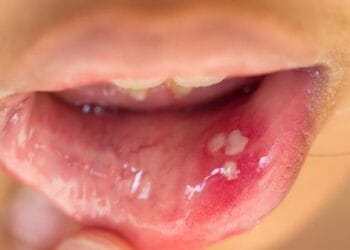 Cara Menyembuhkan Sariawan```