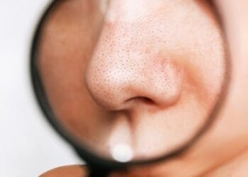 Menghilangkan Komedo